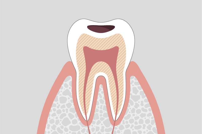 象牙質に達する虫歯