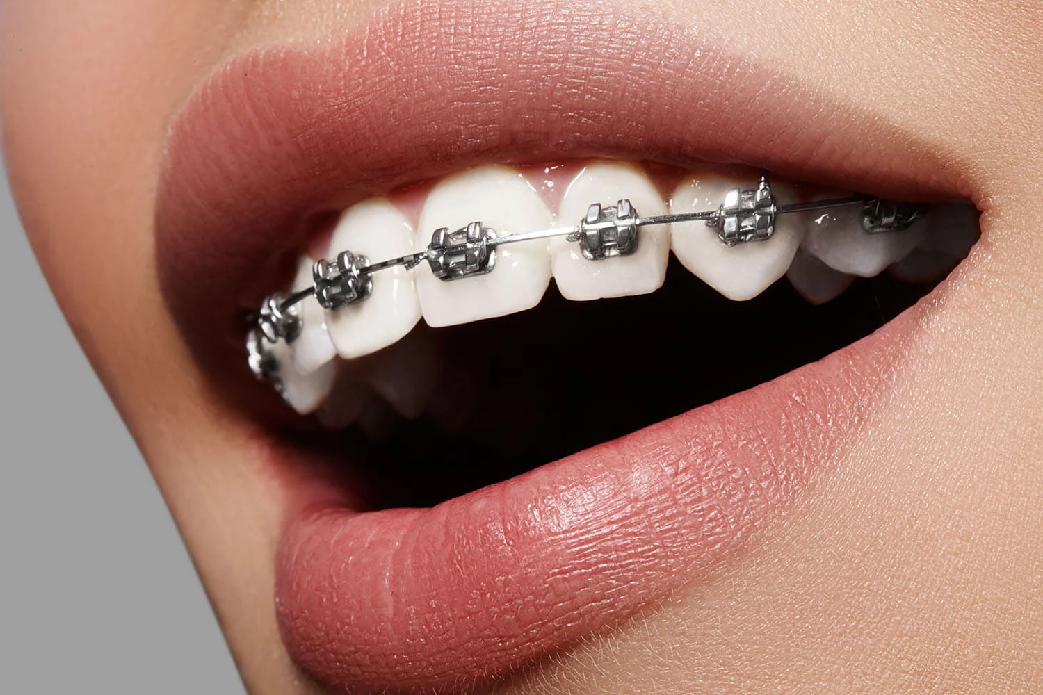 Fitting of orthodontic appliances and start of treatment